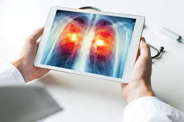 Obtenga información sobre la enfermedad pulmonar obstructiva crónica (EPOC)