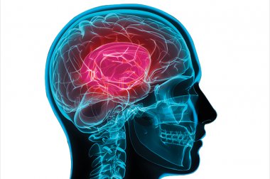 Conciencia y prevención del accidente cerebrovascular