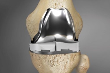 Knee Replacement ConforMIS Knee Replacement