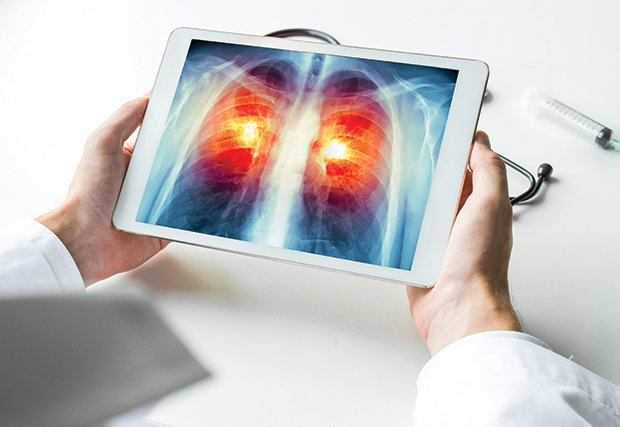 Obtenga información sobre la enfermedad pulmonar obstructiva crónica (EPOC)