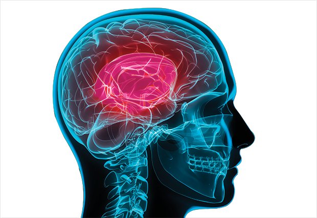 Conciencia y prevención del accidente cerebrovascular